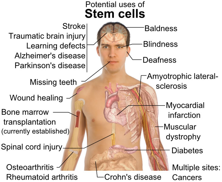 This diagram features the potential uses of stem cells. While it is a topic of great debate, stem cells offer potential uses for conditions such as blindness, Parkinson's disease, diabetes, strokes, deafness, spinal cord injuries, cancers and bone marrow transplants.