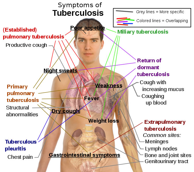 Tuberculosis Symptoms Diagram Free Health Medical Pictures 