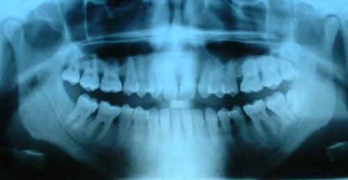 This is an x-ray photo of human teeth. The photo shows that the 
roots of teeth run deep into the mouth.