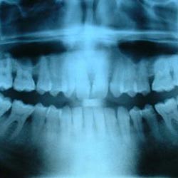 Teeth x-ray