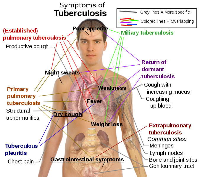 This health diagram gives a detailed overview of tuberculosis symptoms. The symptoms include chest pain, coughing up blood, lymph nodes, fever and weakness.