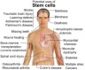 stem cell treatment