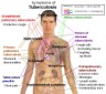 tuberculosis symptoms