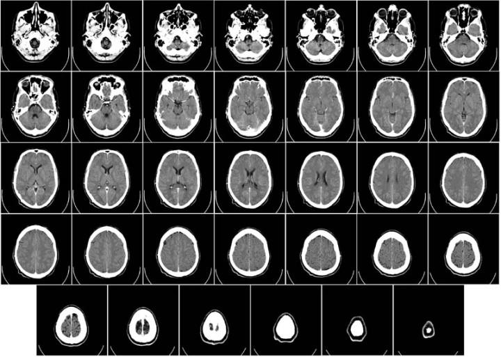 This brain tomography x-ray image shows 34 different slices of a human brain. A device called a tomograph is used to take these kind of images