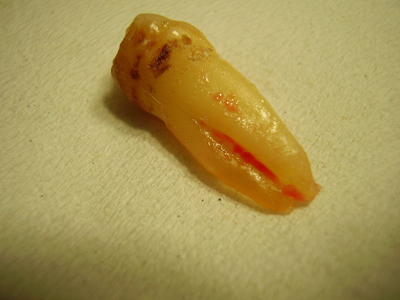 This close up photo shows a dirty looking human tooth.